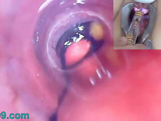 Mature woman peehole endoscope camera in bladder with balls